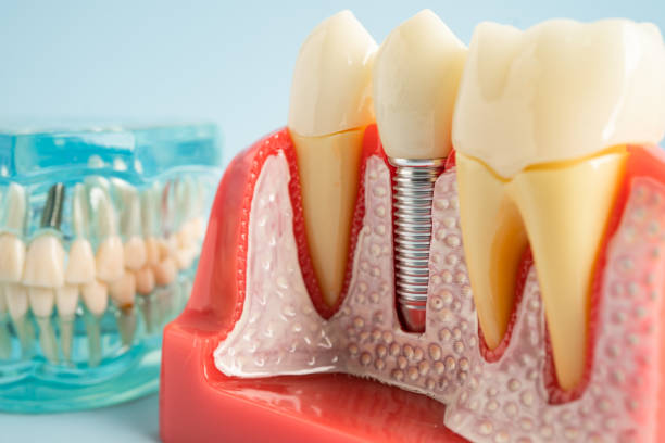 Best Wisdom Tooth Removal  in Bluewell, WV